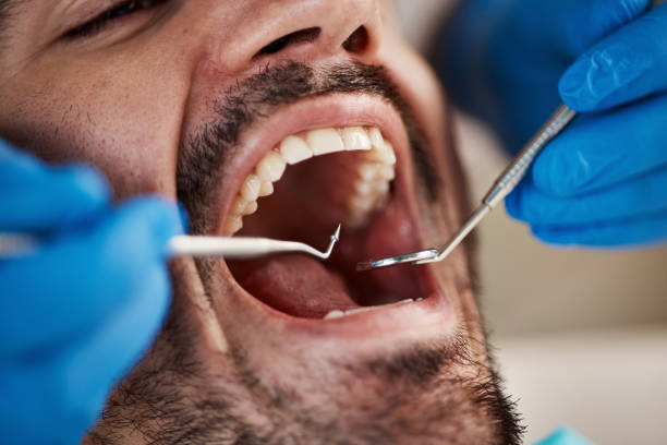 Best Urgent Care for Lost Fillings or Crowns in Azalea Park, FL